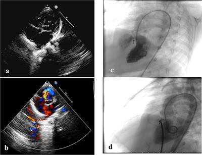 Management of Late-Onset Complete Atrioventricular Block Post Transcatheter Closure of Perimembranous Ventricular Septal Defects